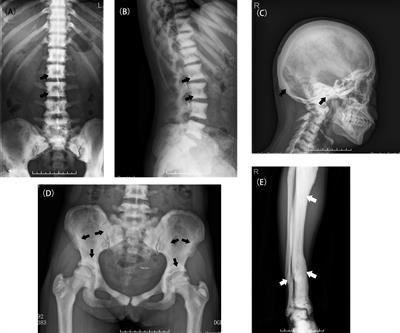 Natural History of Type II Autosomal Dominant Osteopetrosis: A Single Center Retrospective Study